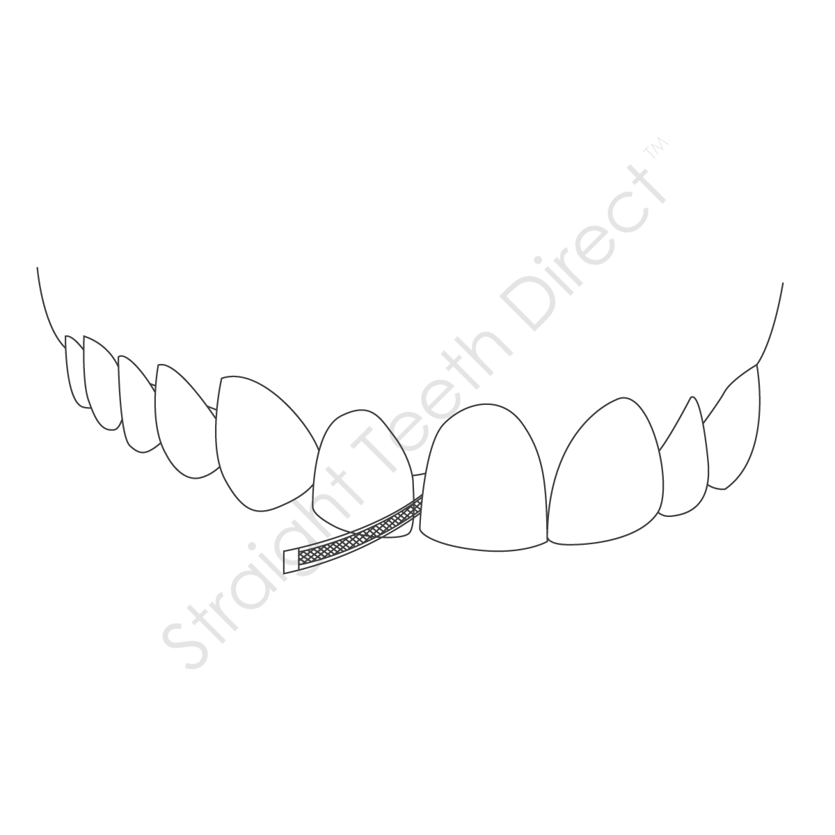 straight-teeth-direct-ipr2