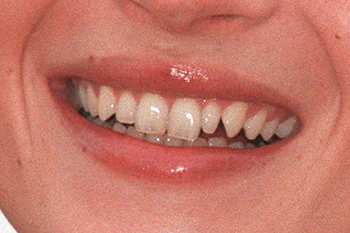 straight-teeth-direct-kate-moss-1