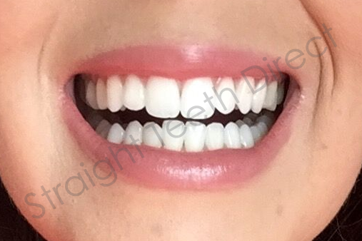 straight-teeth-direct-smilequiz-front-on