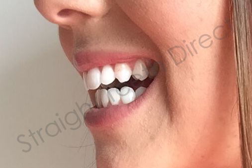 straight-teeth-direct-smilequiz-left-side