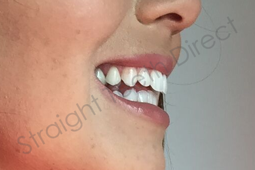 straight-teeth-direct-smile