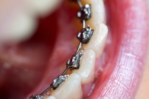 lingual-braces-rather-than-Remote Aligners