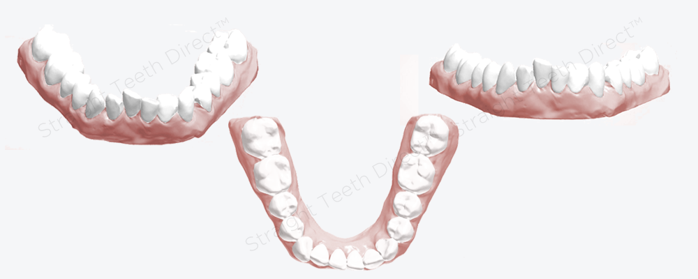 lower-teeth-are-very-crowded-and-uneven-before-cosmetic-improvement