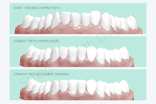 first teeth not straight