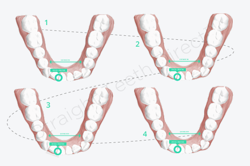 journey-of-straight-teeth-with-clear-aligners