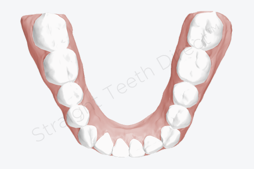 straight-teeth-with-clear-aligners