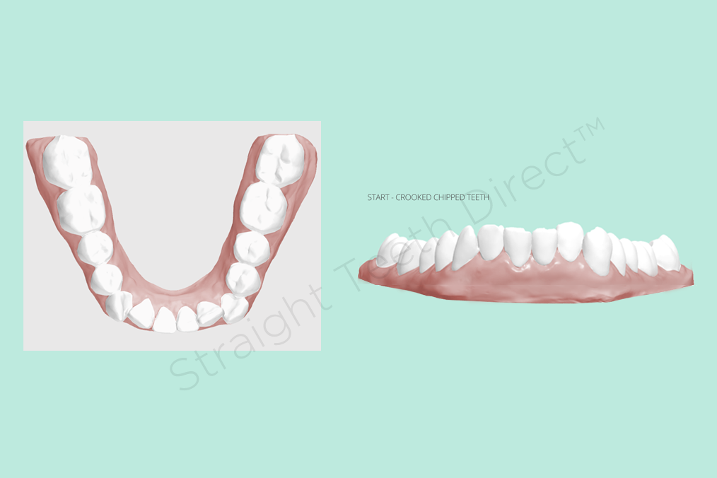 straighten-crooked-teeth-with-clear aligners