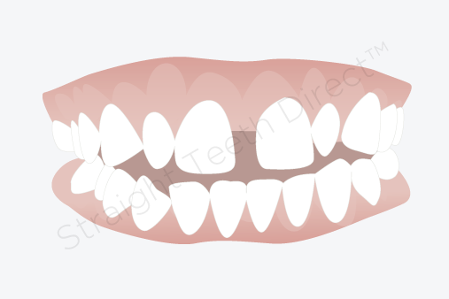 front teeth gap bands