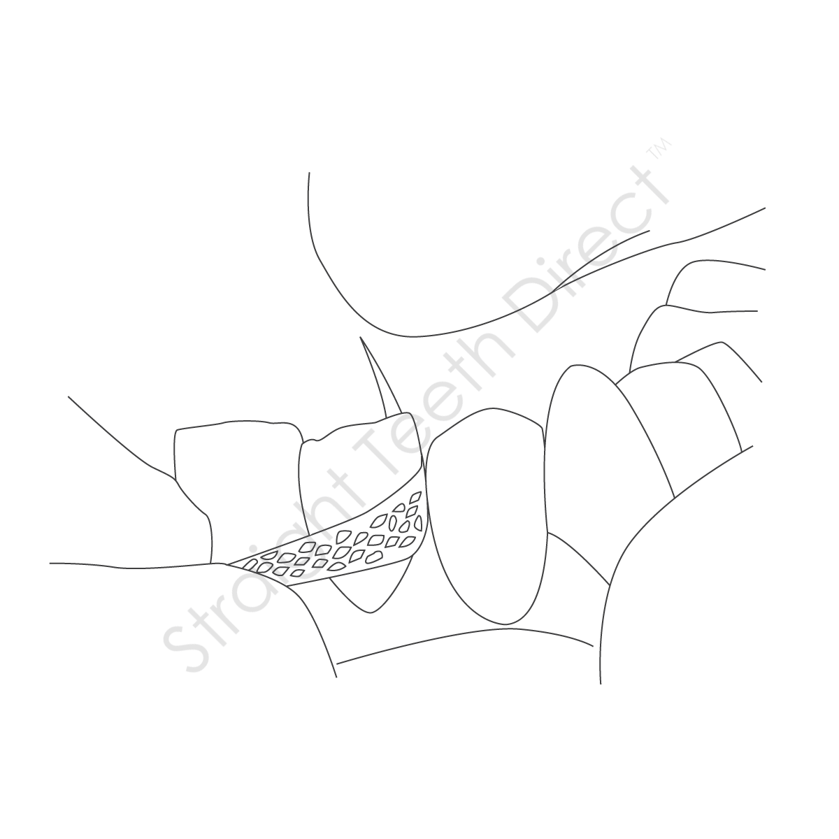 straight-teeth-direct-ipr