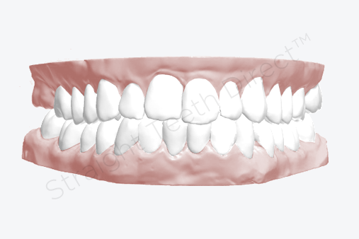 after-using-aligners-theyre-much-straighter-with-cosmetic-improvement