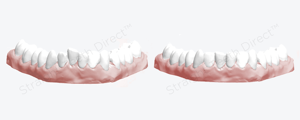 crooked-lower-teeth-now-a-naturally-looking-aligned-smile
