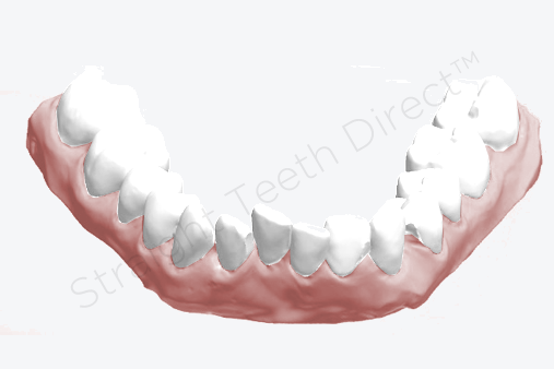 example-of-narrow-the-lower-jaw-and-crooked-lower-teeth