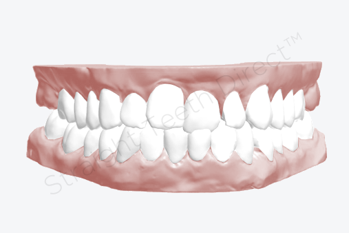 front-teeth-uneven-example-before-cosmetic-improvement