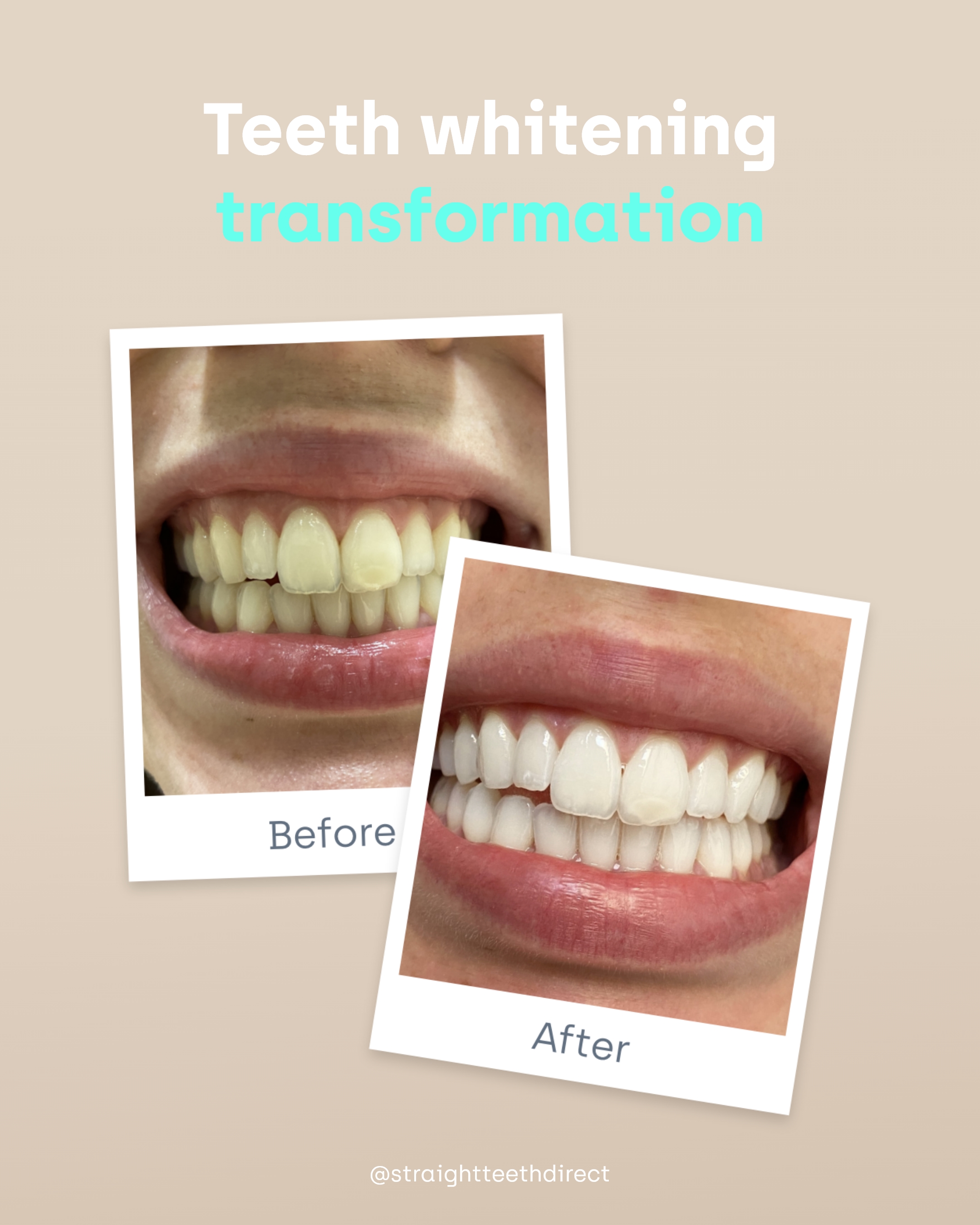 teeth whitening transformation