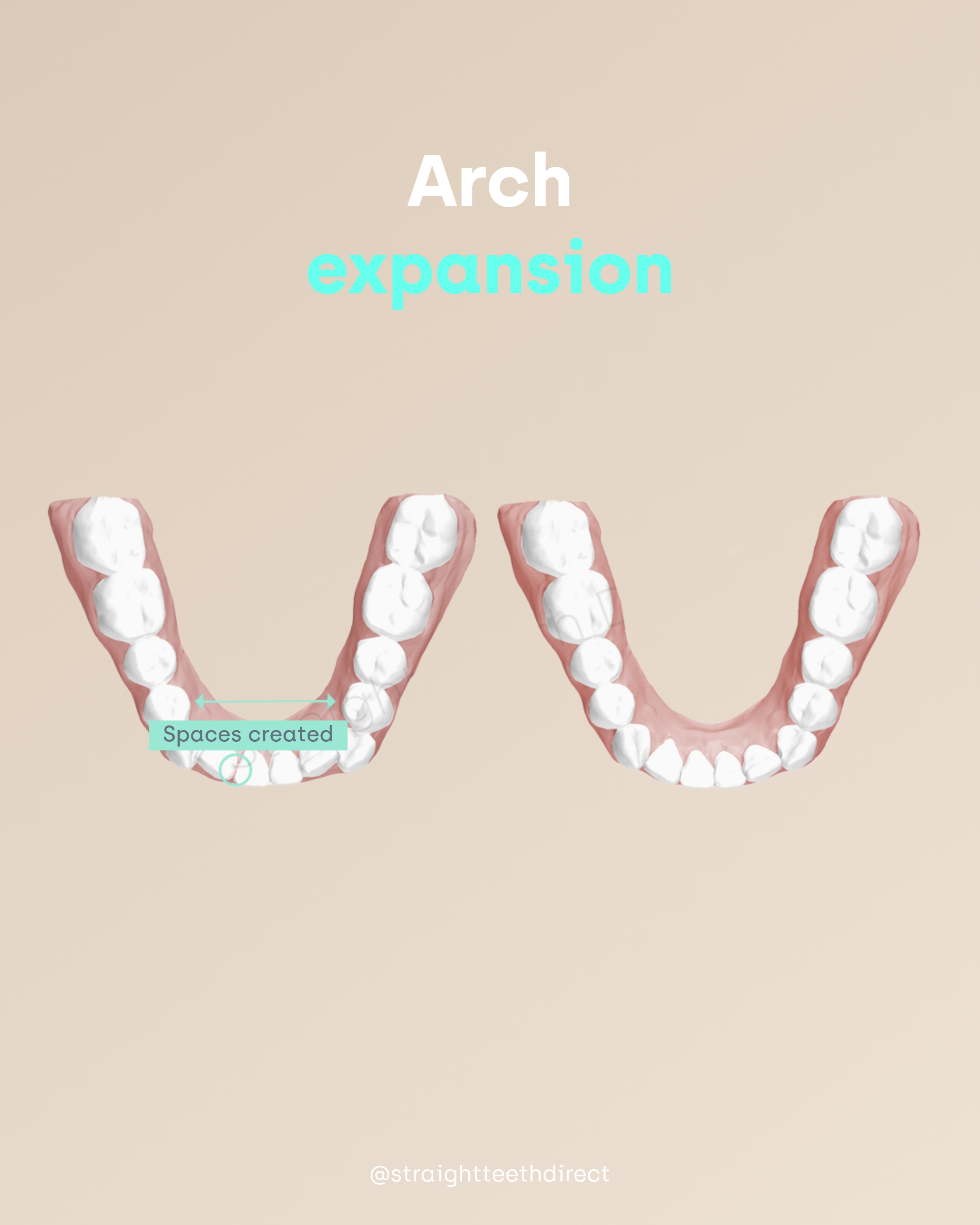 arch expansion example