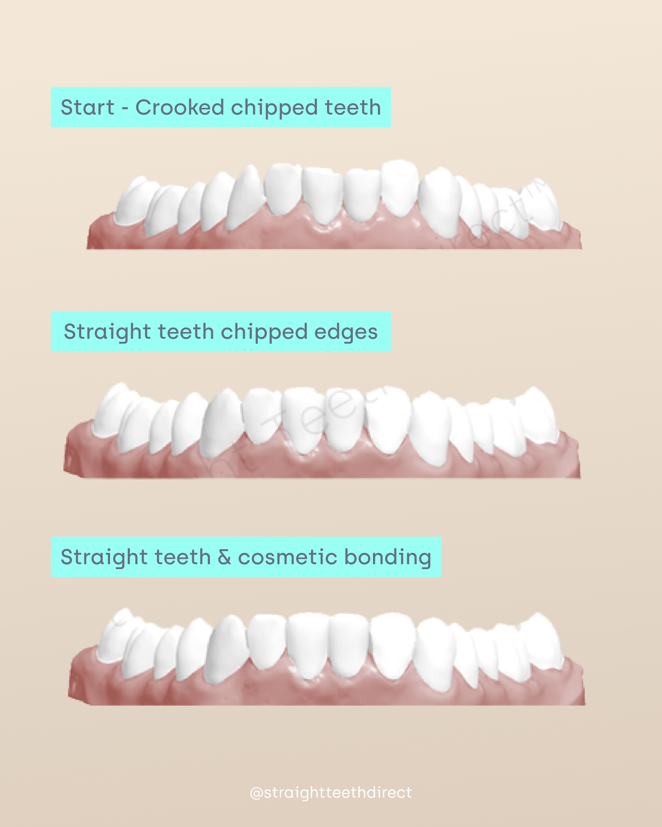 phases of cosmetic teeth bonding