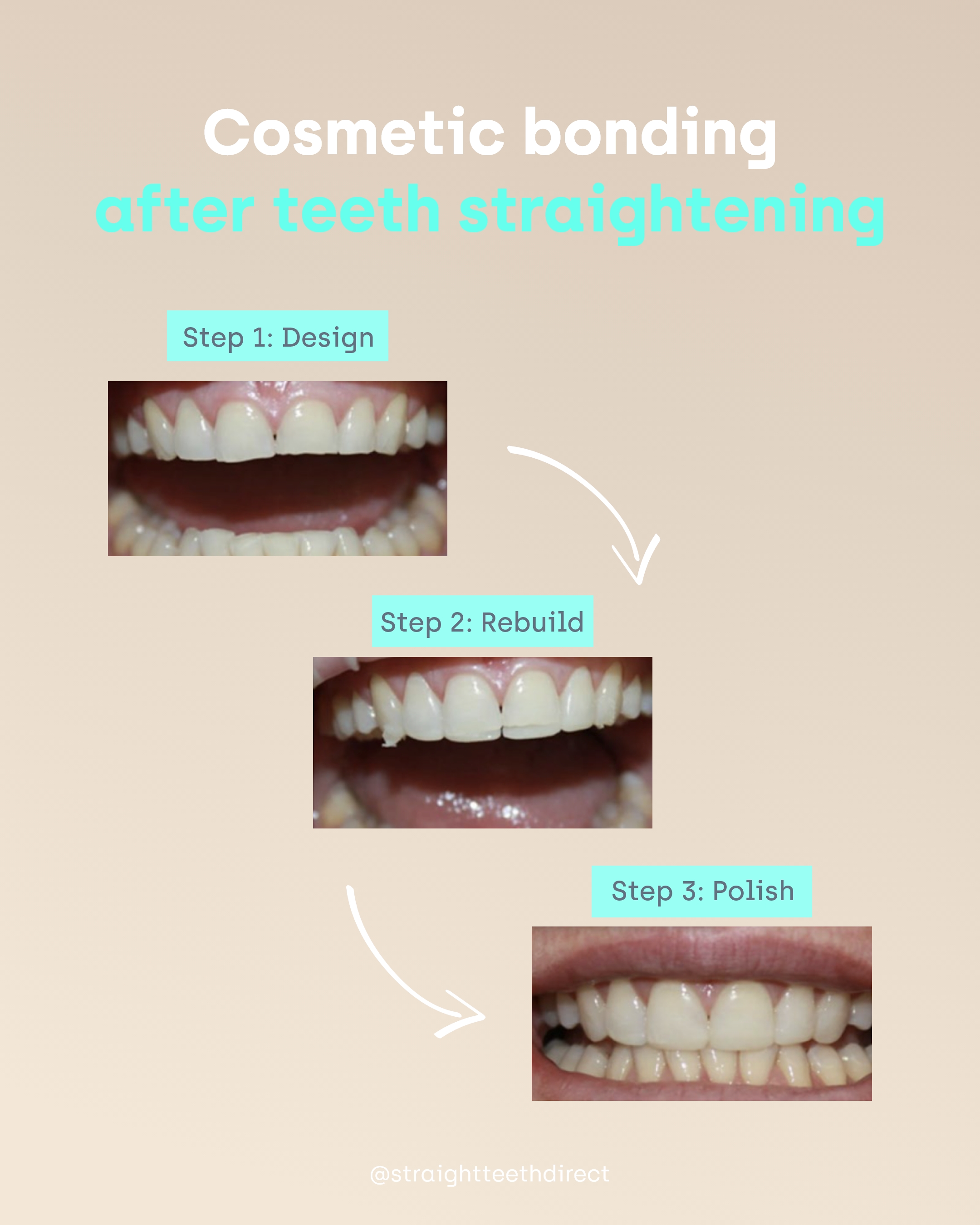 Cosmetic bonding after teeth straigtening
