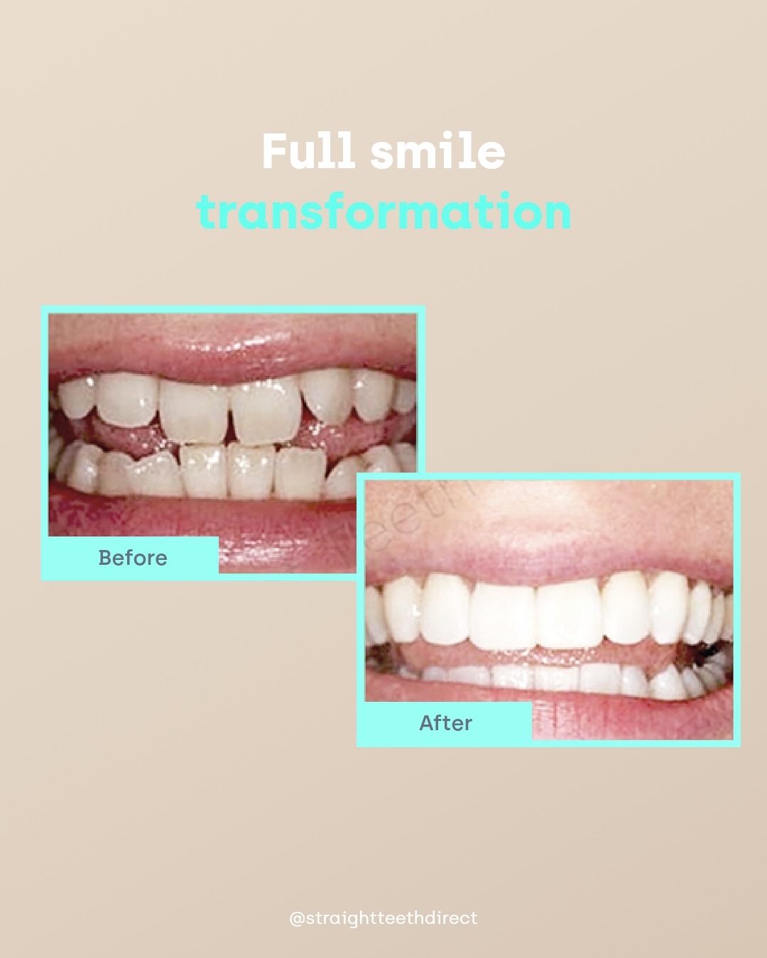 cosmetic bonding full smile transformation