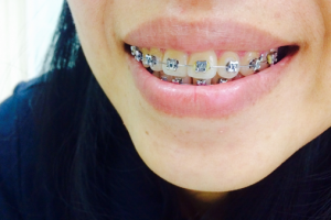 traditional-braces-vs-Remote Aligners