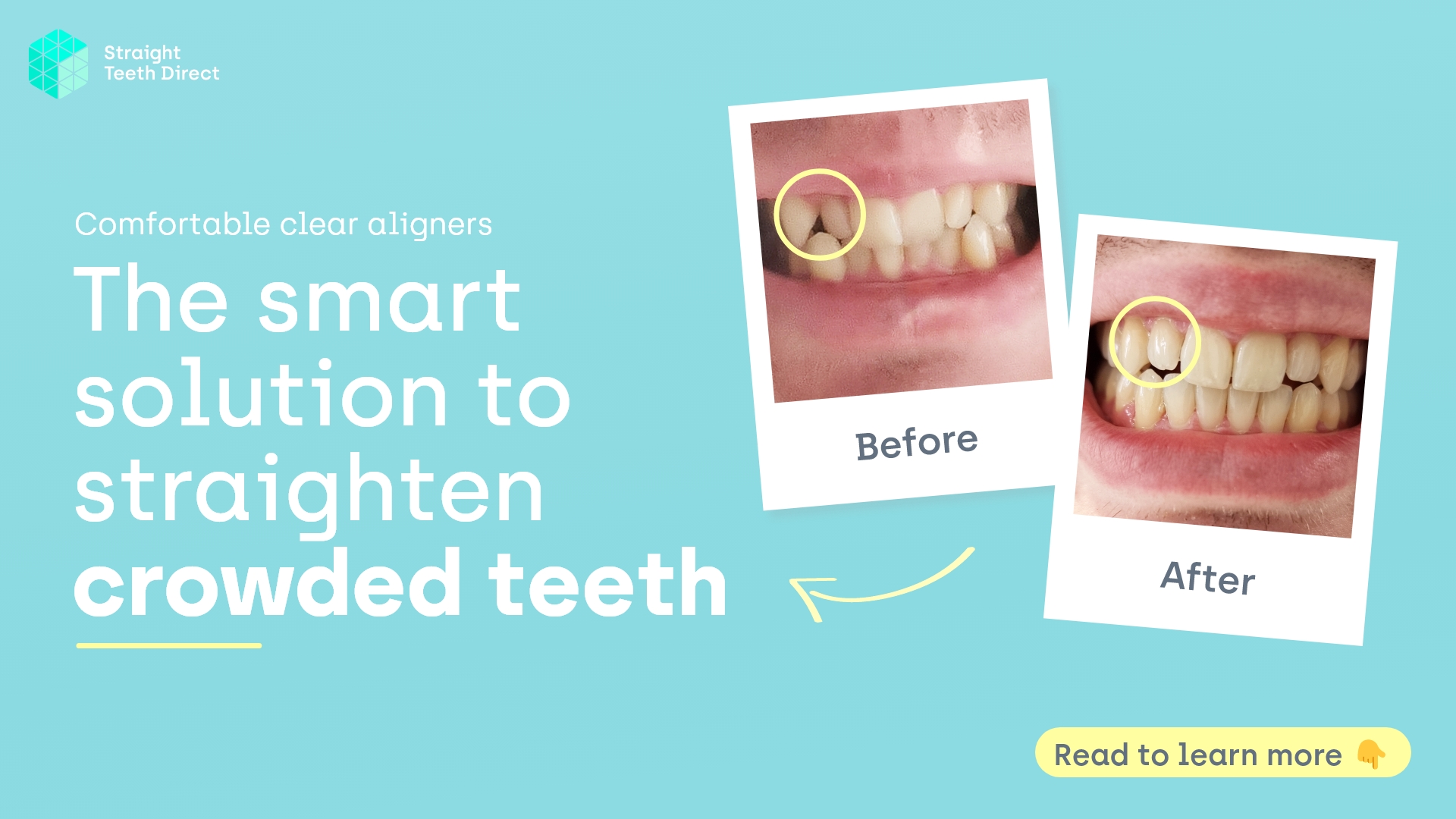 The smart solution to straighten crowded teeth blog