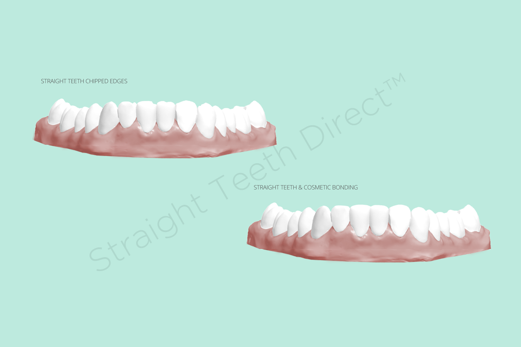 clear-aligners-the-solution-to-straighten-crowded-teeth