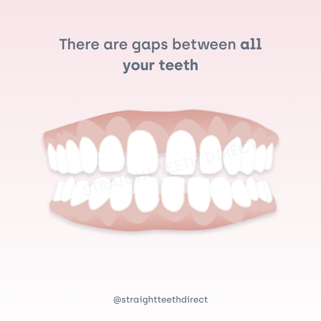 gaps between all teeth