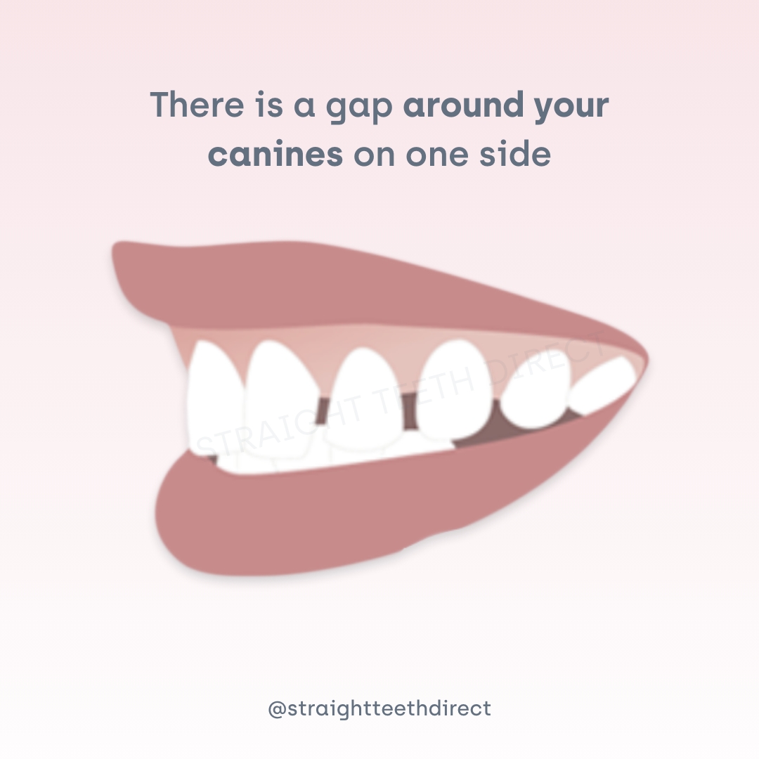 gap around your canines on one side