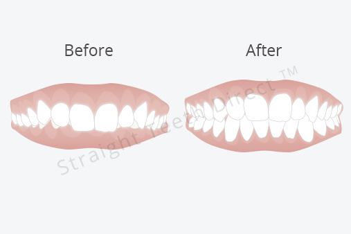 overbite