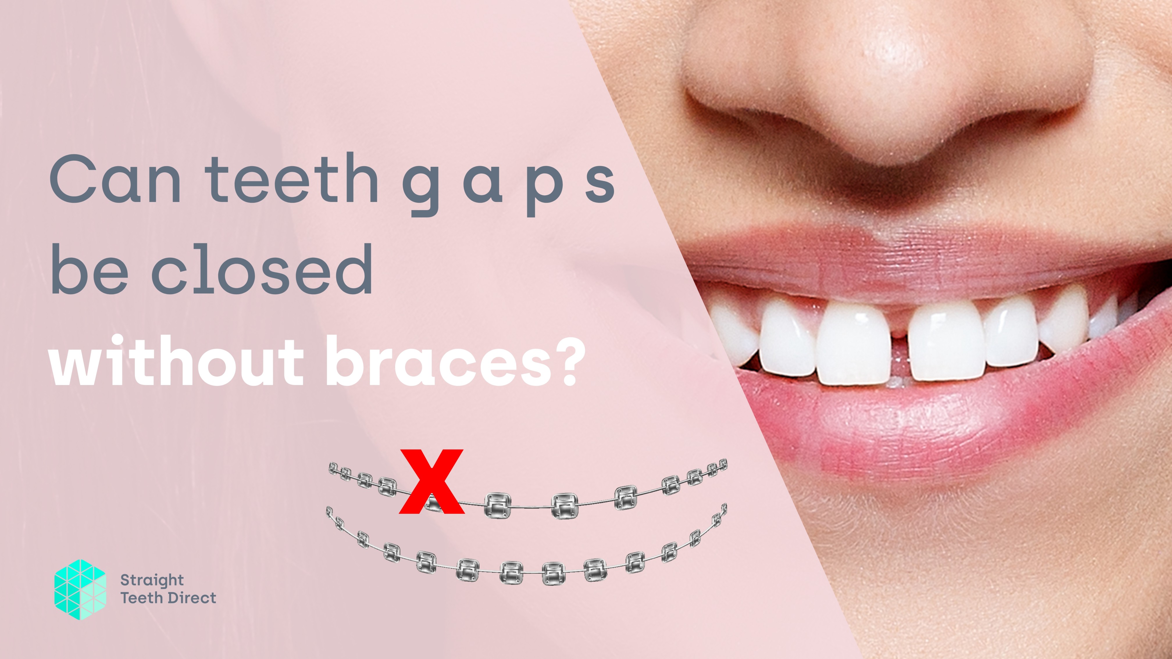 Teeth gaps: can they be closed without the use of braces?