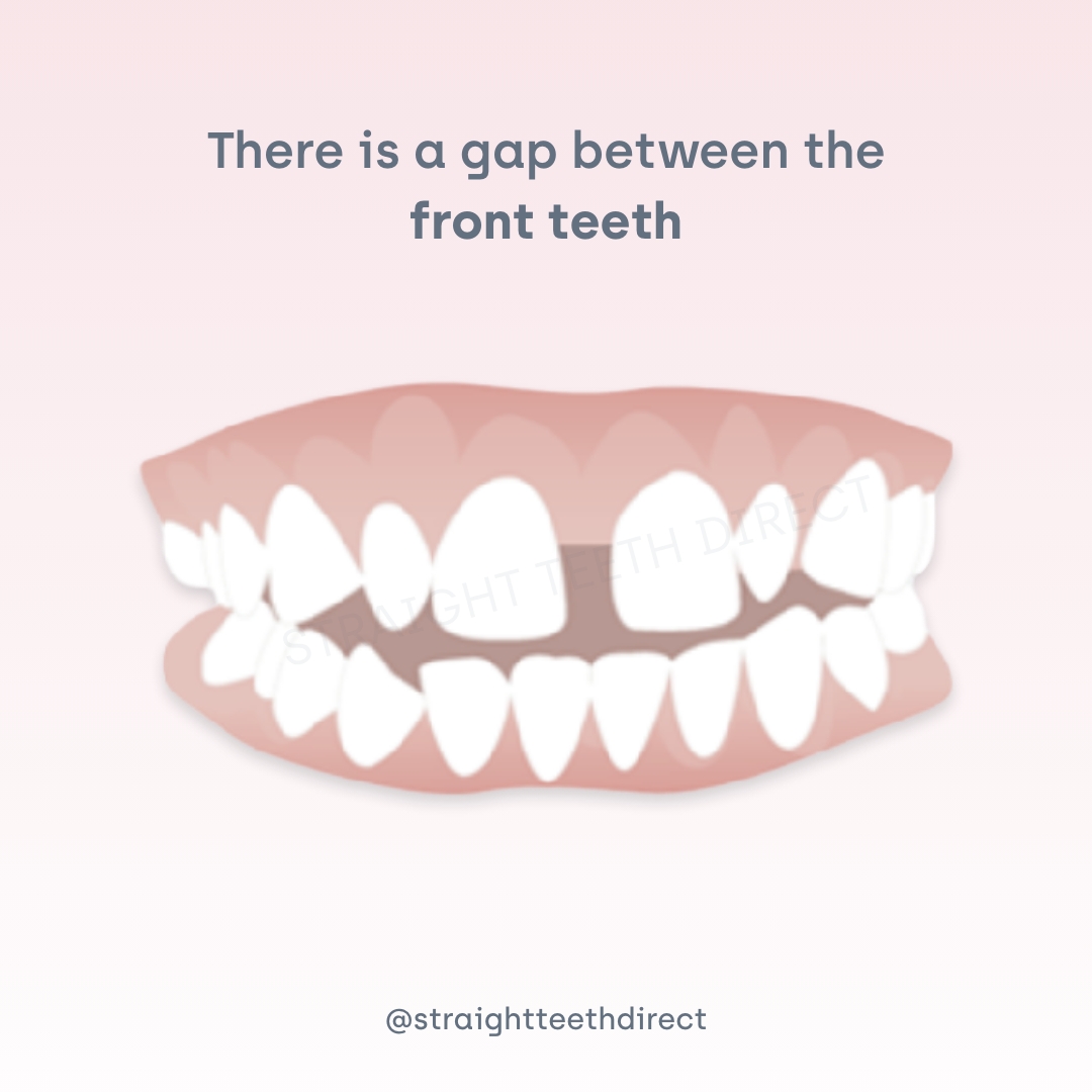 gap between the front teeth