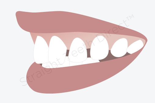 Teeth Gaps Can They Be Closed Without The Use Of Braces