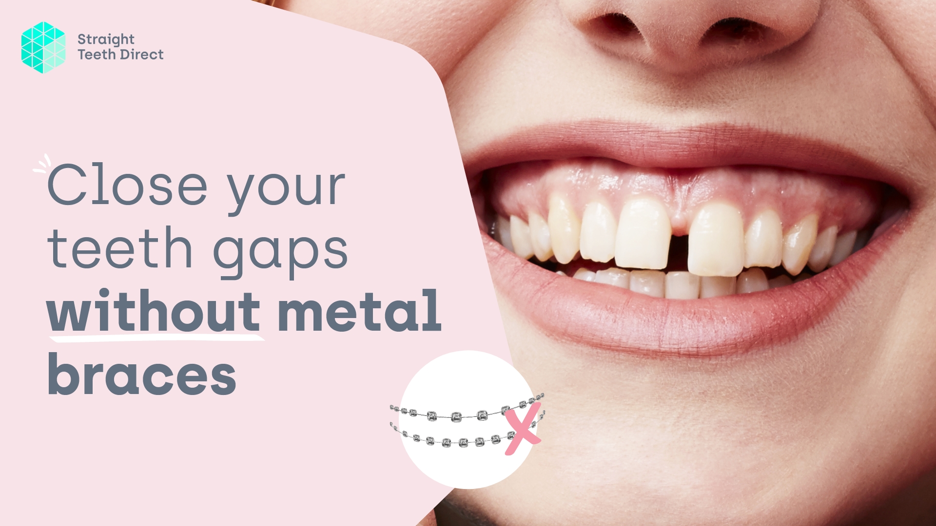 Can teeth gaps be closed with no braces