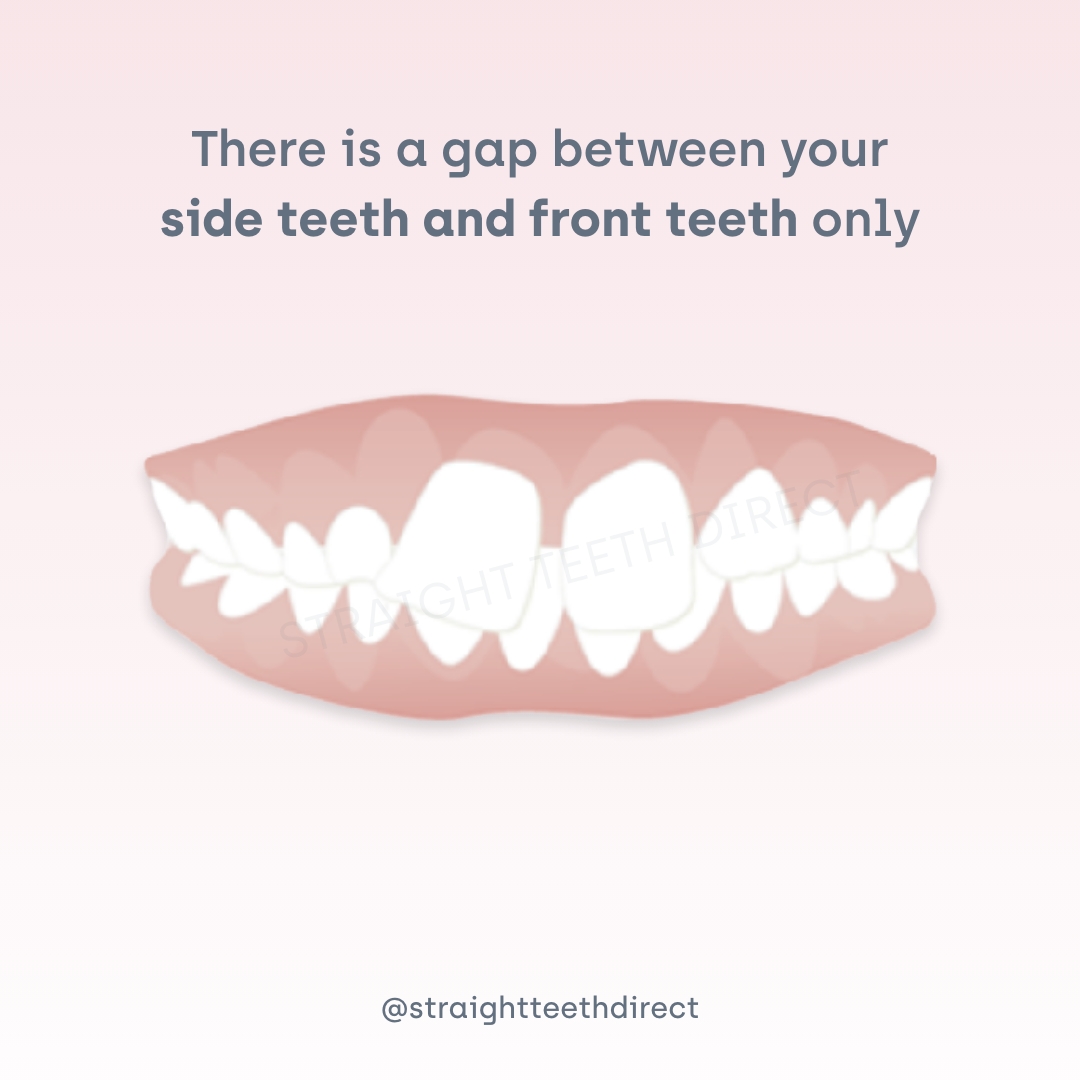 gap between your side teeth and front teeth