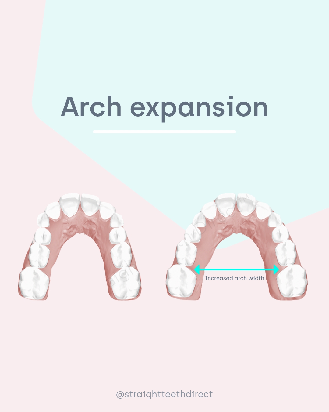 Arch expansion