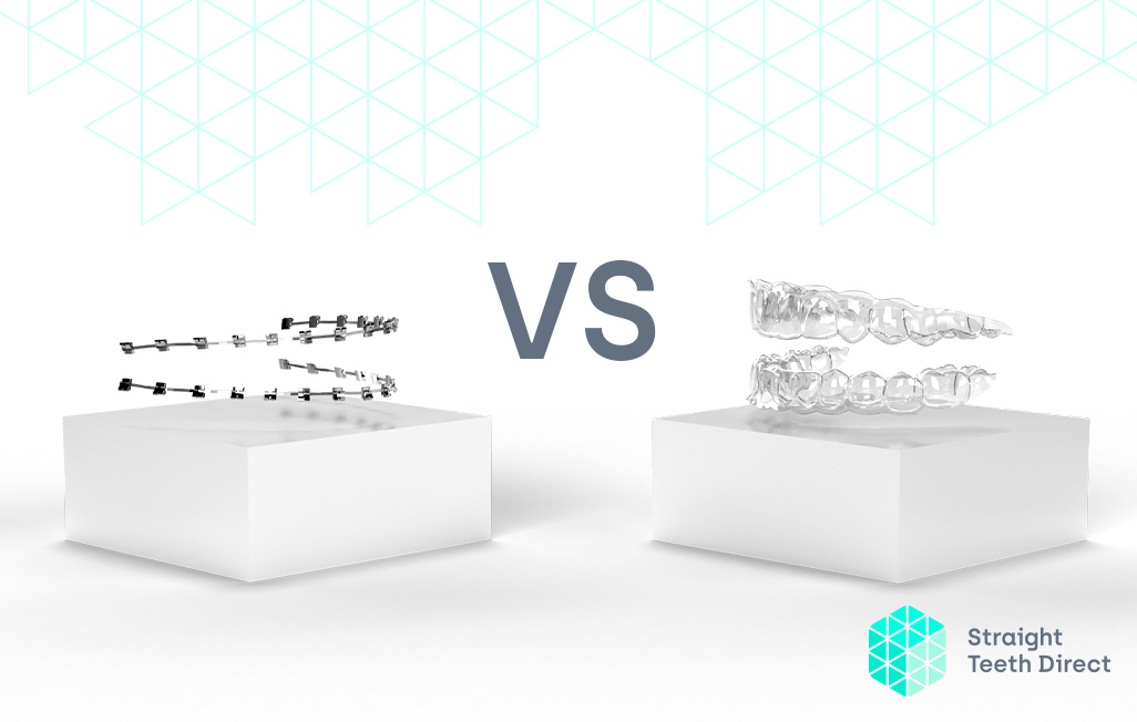 fixed braces vs clear aligners