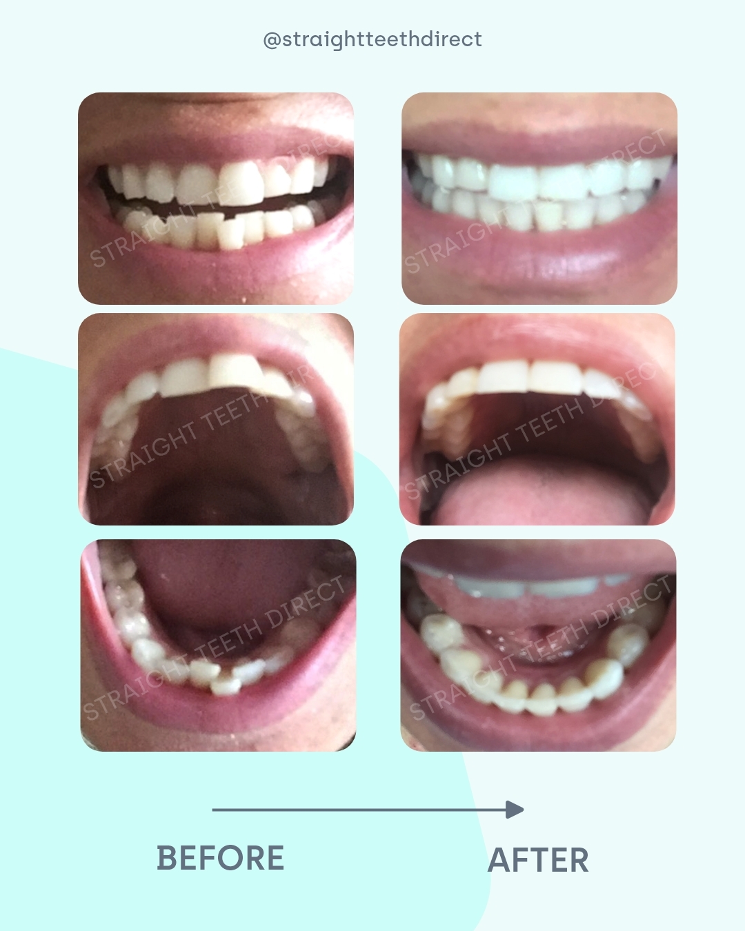 Katie before and after clear aligners while pregnant