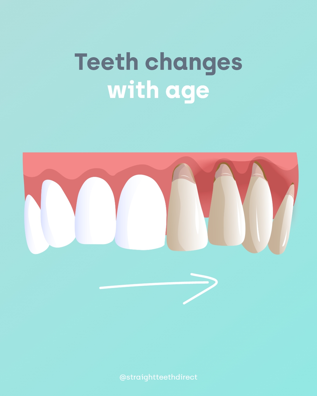 Teeth changes with age