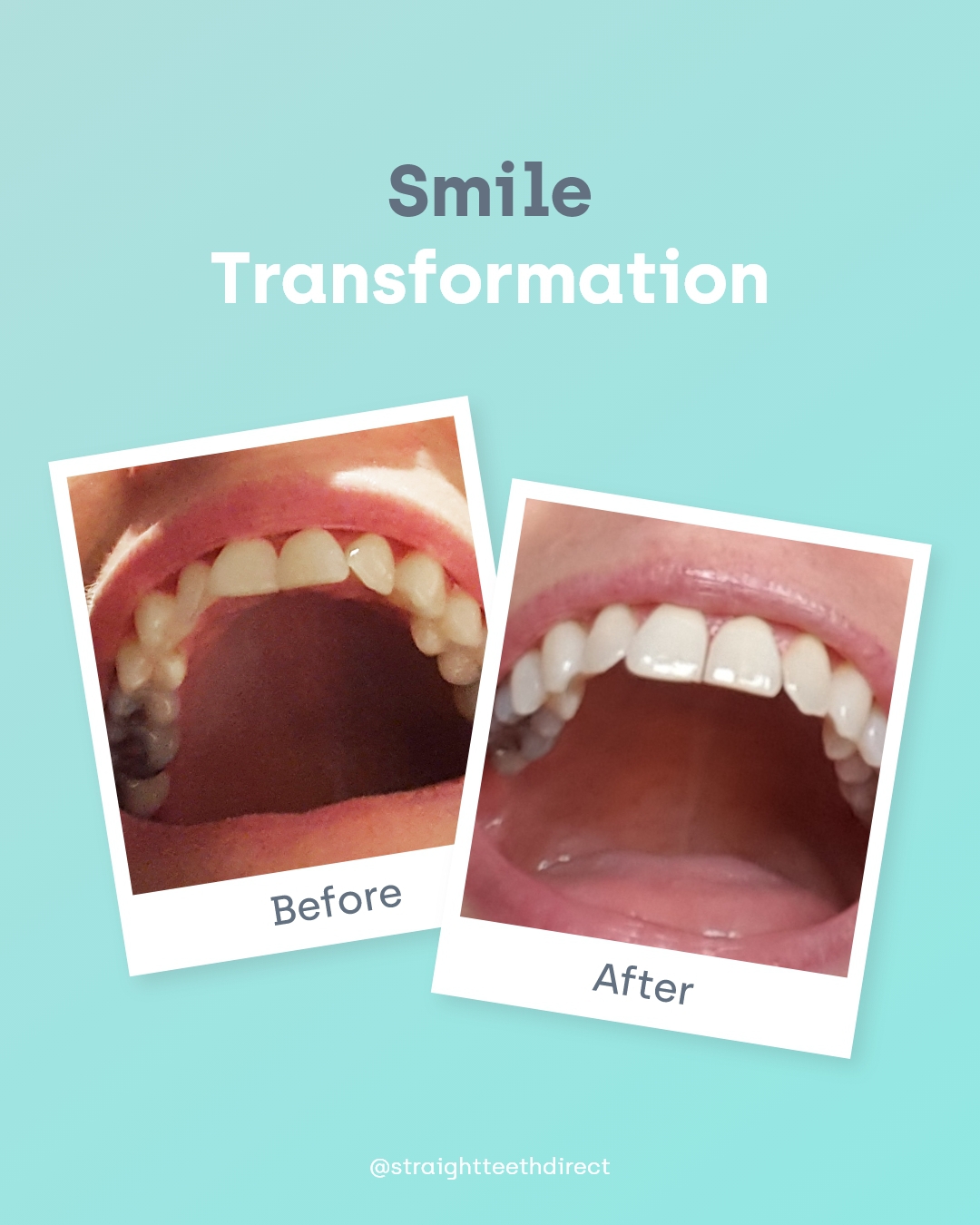 Vicky Lou smile transformation