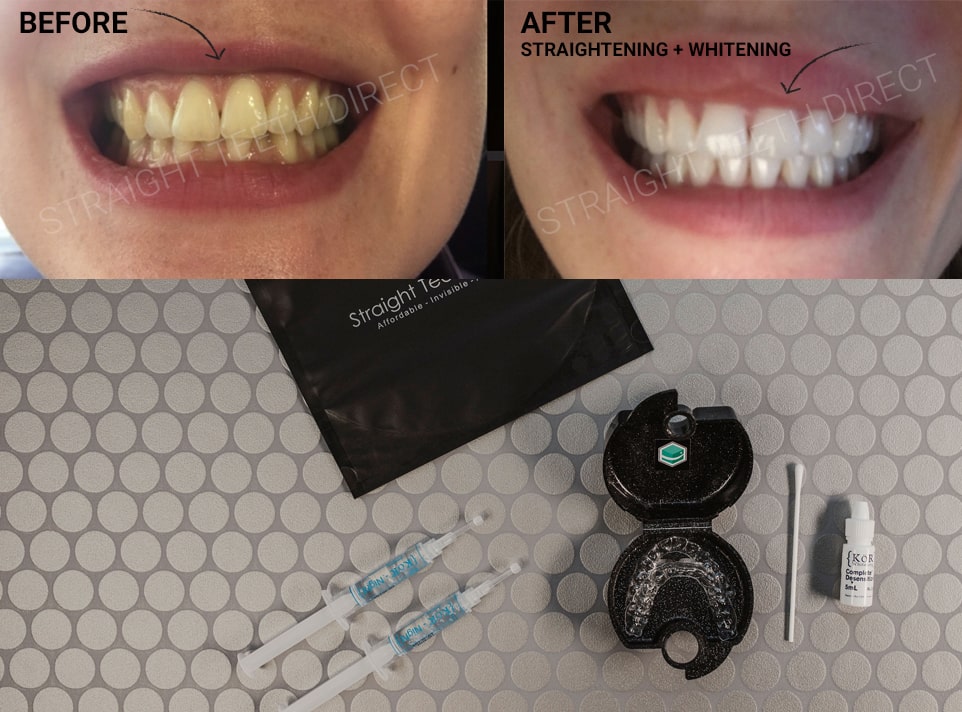Dentist prescribed teeth whitening