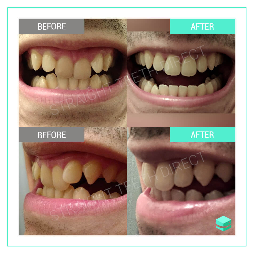 is smile direct club good for overbite