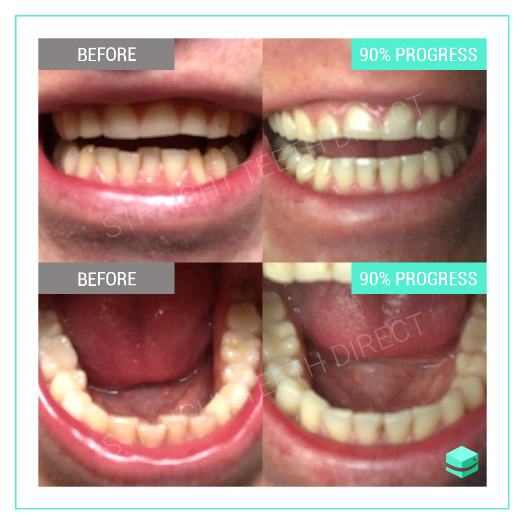 teeth braces without gaps max