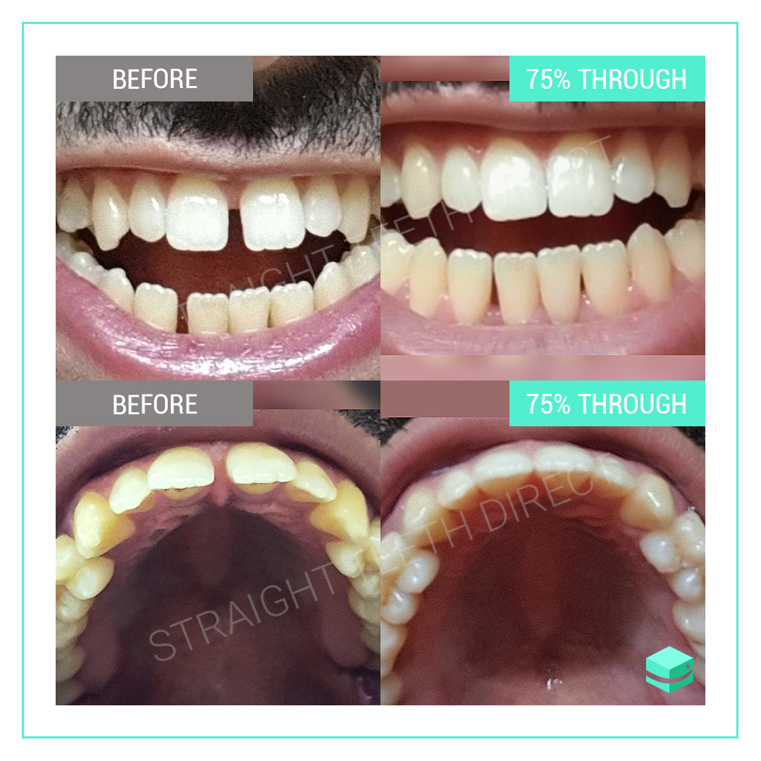 i stopped wearing my retainer and my teeth shifted i stopped wearing my retainer and my teeth shifted