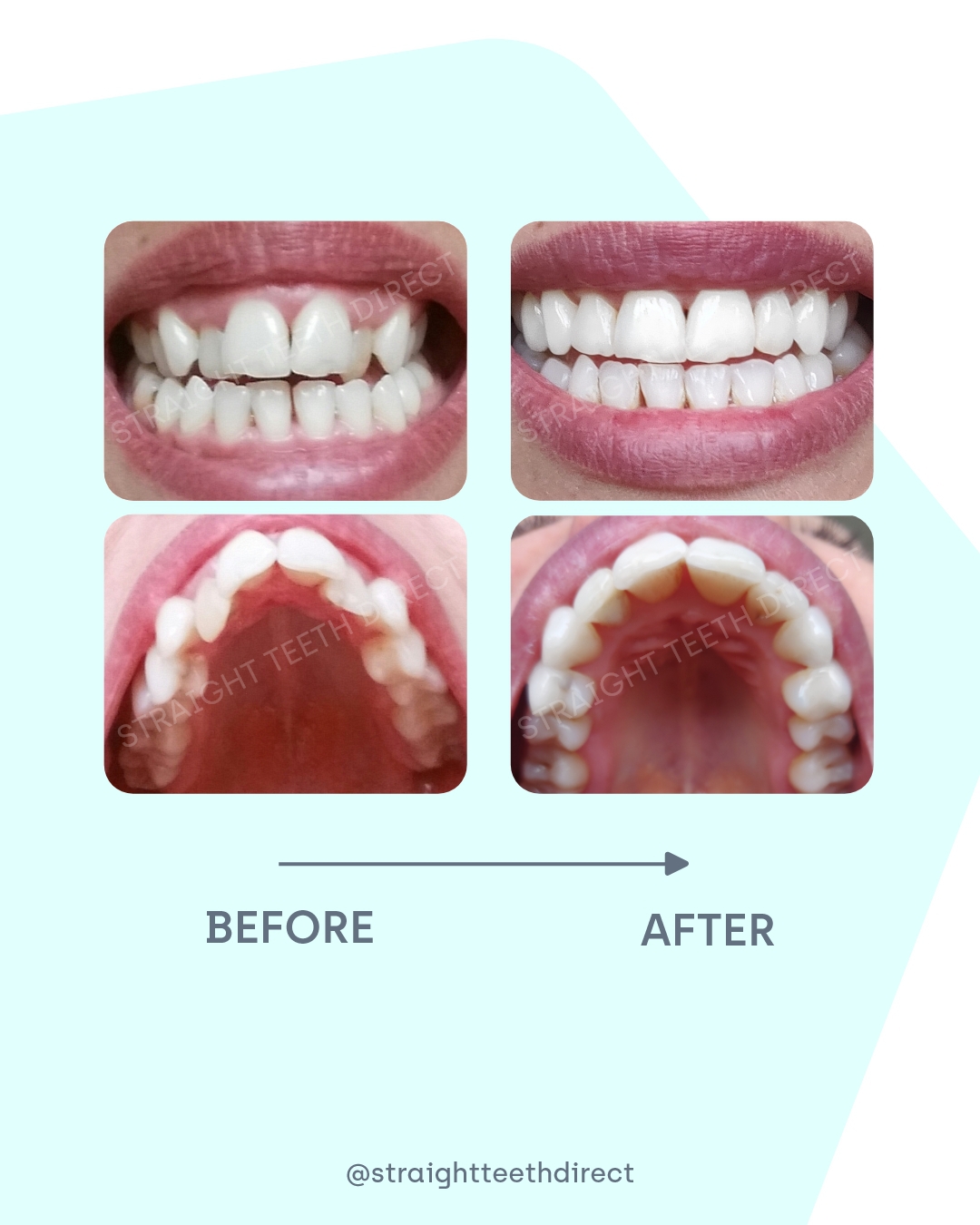 Marta before and after review with clear aligners