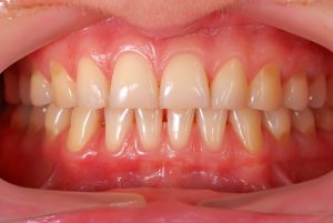 Gum health: Thin Biotype