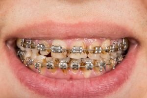 Gum health: fixed braces