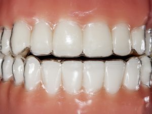 Gum health: clear aligners