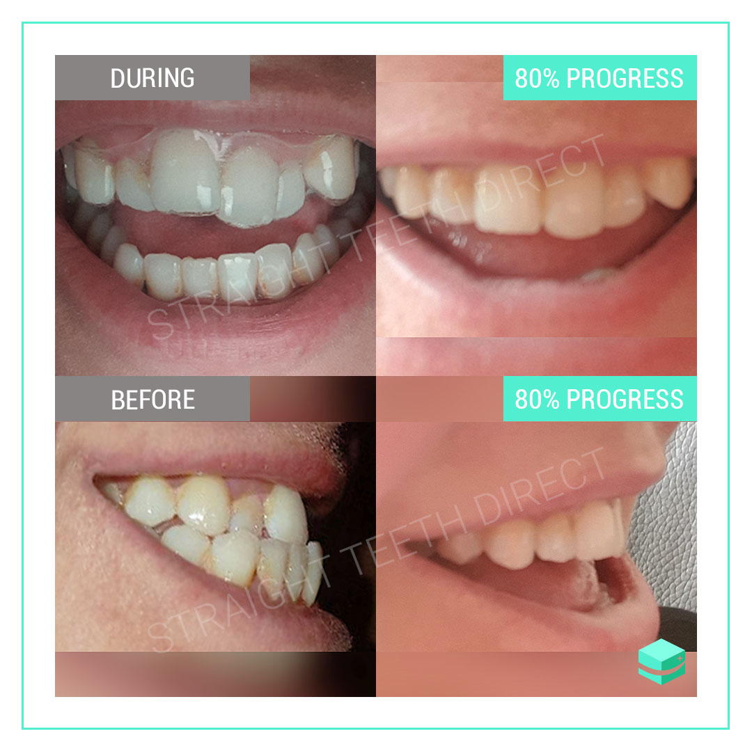 teeth crowded crooked lower smile clear aligners straighten lucie