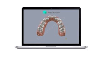 Dental impressions stage 5