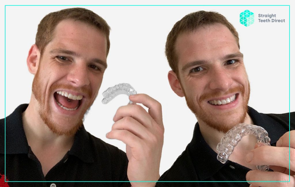 Photo inspiration: Online Teeth Straightening Ben S Own Straight Teeth Direct Journey Photo Inspiration