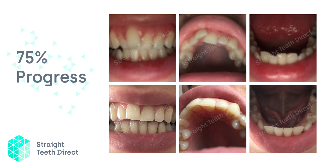 Aligners delivered direct - Toni my journey Straight Teeth Direct